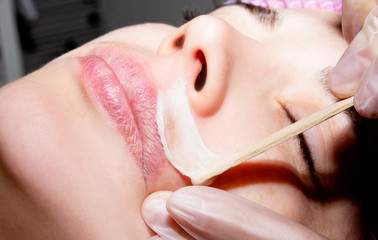Depilation with hot wax mustache in the beauty salon. Young woman receiving facial epilation close up. Cosmetologist removes hair on face. Beauty salon, mustache depilation. - obrazy, fototapety, plakaty