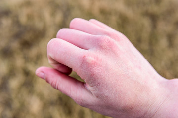 Dry and chapped skin on hand. 