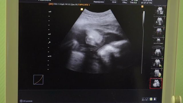 Ultrasound monitor screen showing baby in mother's womb