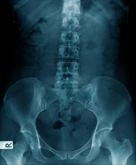 old man x-ray, lumbar x-ray image with pelvic bone