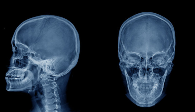 skull x-ray image AP