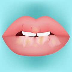 Dry mouth vector illustration
