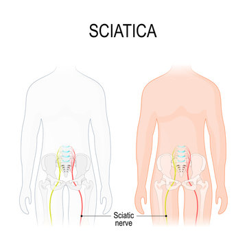sciatica. Human body with Sciatic nerve.