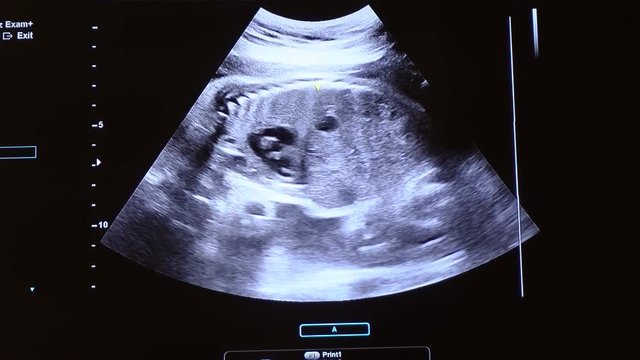 2D Ultrasound display of 28 weeks pregnant. Fetus ultrasound image that show important organs.