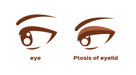 ptosis of eyelid . eye sickness anatomy vector