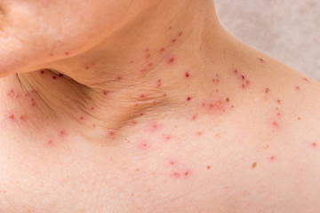 Traces of removal of papillomas on the neck of a woman_