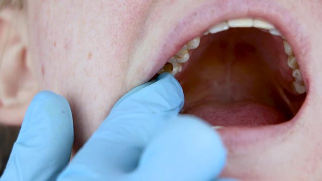 The hole in the tooth and the treatment of dental canals. Treatment of periodontitis in the dental clinic