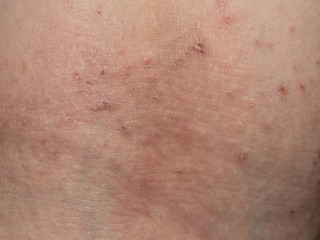 A rash on the skin.