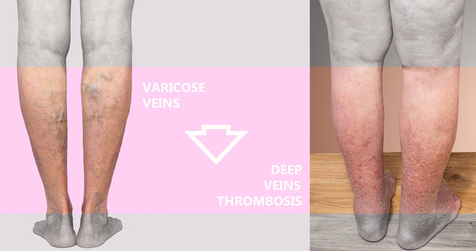 Hyperpigmented Lower limb secondary to venous insufficiency.