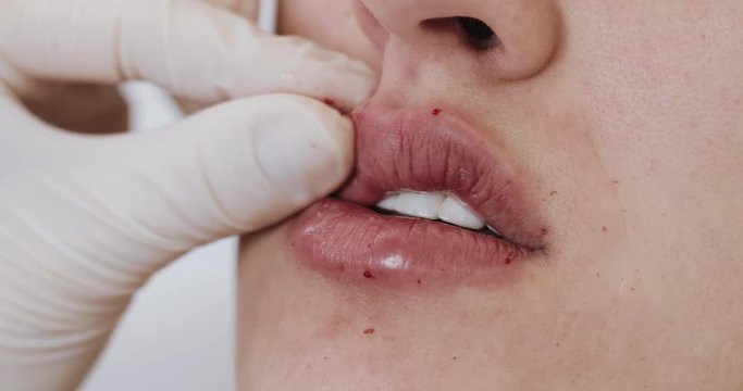 Lip Augmentation, close up. The doctor cosmetologist makes lip augmentation procedure of a beautiful woman in a beauty salon. Cosmetic beauty injection concept