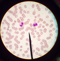 Blood cell Picture show Neutrophil morphology
