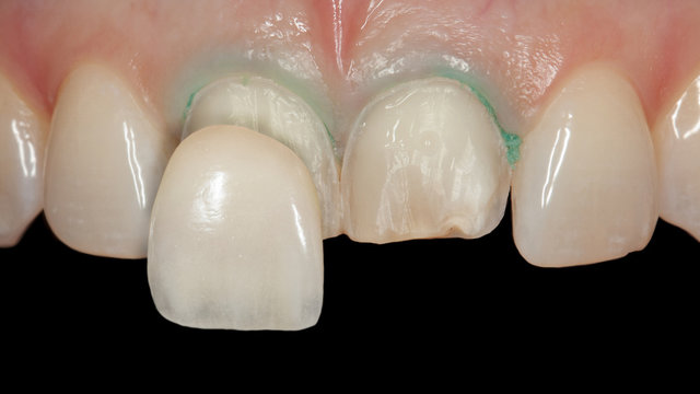 Zahn Veneer aus Keramik auf den oberen großen Schneidezähnen Behandlungsablauf