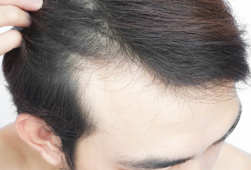Young man serious hair loss problem for health care medical and shampoo product concept