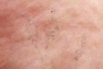 The varicose veins