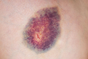 Closeup on a Bruise on wounded woman leg skin. Close up on a bruise on wounded woman leg skin....