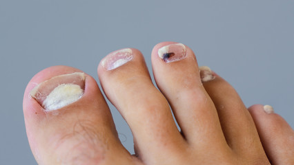 Single Right Male Foot with a Fungal Infection in the Toe Nails which are cracked and dry skin, Middle Toe with a bruise. Feet In Need of medical treatment by a doctor on a grey blurred background.