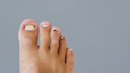 Single Right Male Foot with a Fungal Infection in the Toe Nails which are cracked and dry skin, Middle Toe with a bruise. Feet In Need of medical treatment by a doctor on a grey blurred background.