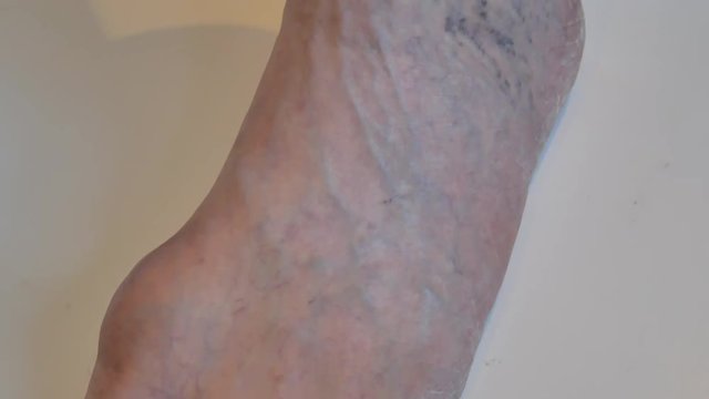 foot of old man with diseases like nail fungus, varicose veins, capillary mesh grid. close-up 4k video footage