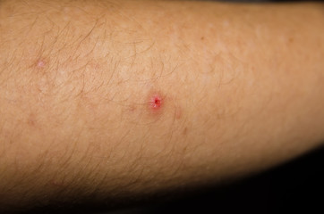 a pimple on the arm