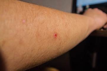 Fototapeta premium a pimple on the arm