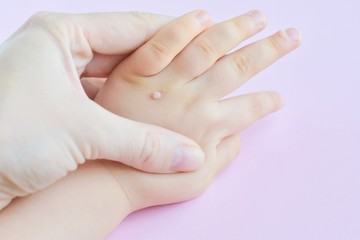 The doctor holds a small hand of a child affected with warts on little fingers and back of the hand. Papillomavirus in a child's hand and fingers. Pediatric dermatology. Skin diseases