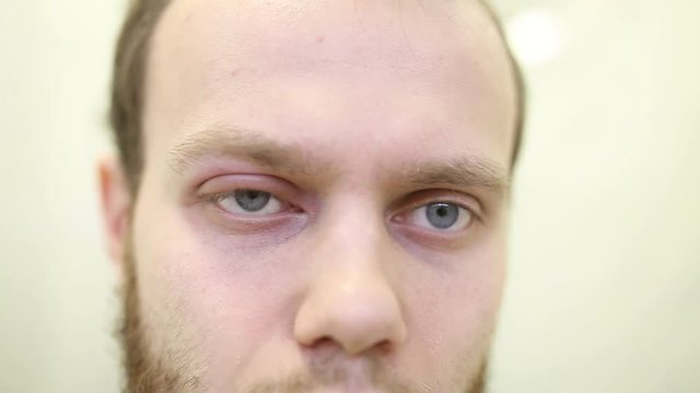 allergic eye reaction in a young man, angioedema urticaria. Quincke's edema