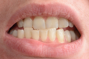 Fototapeta premium A young woman shows her crooked teeth that needs medical help in close-ups