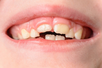 The child opens wide mouths, showing his crooked teeth after falling of milk teeth
