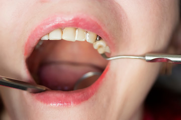 Treatment of sick teeth at the dentist.