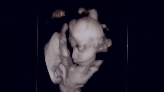 4d scan Pregnant Ultrasound of a baby fetus at 23 weeks 