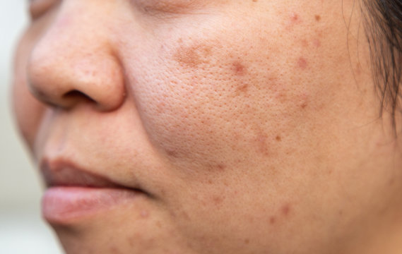 Problems facial skin is acne and blemishes.