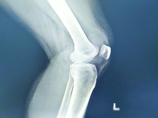Knee joint x-ray lateral views Fracture tibial eminence is suspected. Left knee joint fluid is seen