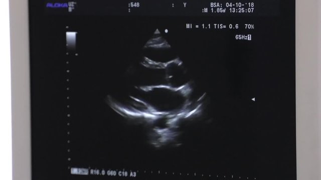 The doctor makes an ultrasound in the hospital. Conducting an ultrasound procedure in a patient. Heart ultrasound image on computer screen.