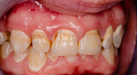 frontal teeth with tooth decay
