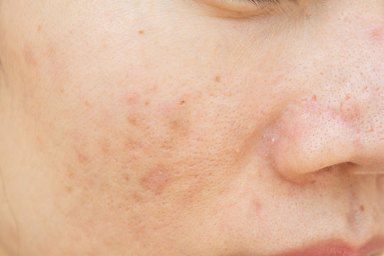 Acne scars and pores. Dark spots. Wrinkles and skin problems