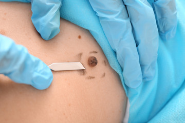 Doctor with lancet going to remove mole from patient's skin, closeup - obrazy, fototapety, plakaty