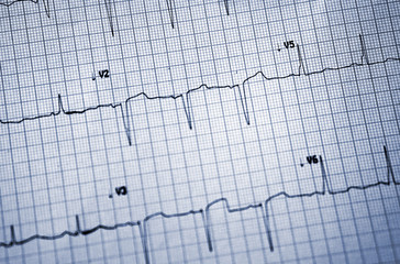 Closeup of ECG report print out with details of patients heart condition
