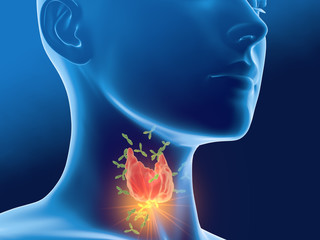 Antibodies attacking thyroid gland of a woman,  Autoimmune thyroiditis, Hashimoto's disease ..