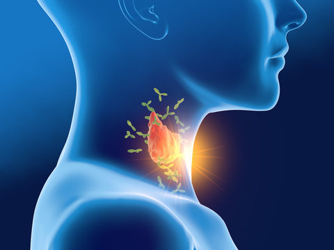 Antibodies Attacking Thyroid Gland Of A Woman,  Autoimmune Thyroiditis, Hashimoto's Disease ..