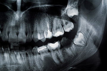 Dental x-ray of a young female molars with teeth problems, fillings and medical care needed. Wisdom...