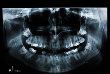Panoramic dental x-ray of a person with teeth problems. Young female radiography. Missing tooth. Fillings and root canal obturation. 