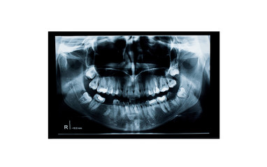 Panoramic dental x-ray of a young girl with teeth problems isolated on white background with empty space for text. 