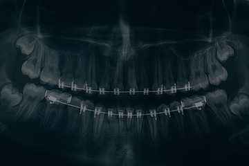 Dental x-ray