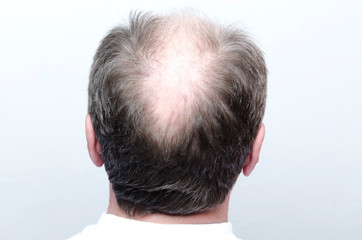 Fototapeta premium Back of male bald head.Concept of baldness