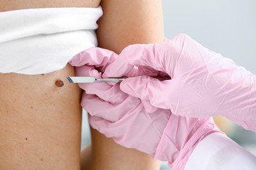 Doctor with lancet going to remove mole from patient's skin, closeup