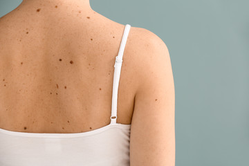 Young woman with moles on grey background