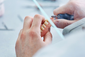 Anfertigung einer Zahnprothese