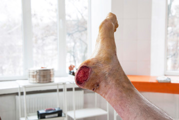 Foot wound becomes infected. Patients with diabetes, foot ulcers