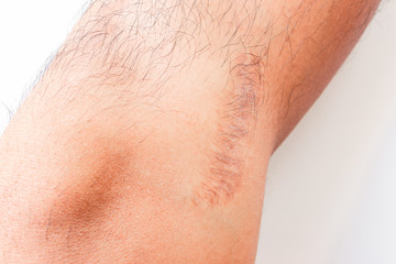 a scar or scars on skin.