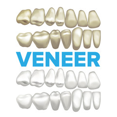 Veneer Vector. Dental Veneer Concept. Medical Banner Design Element. Tooth Before After. Illustration